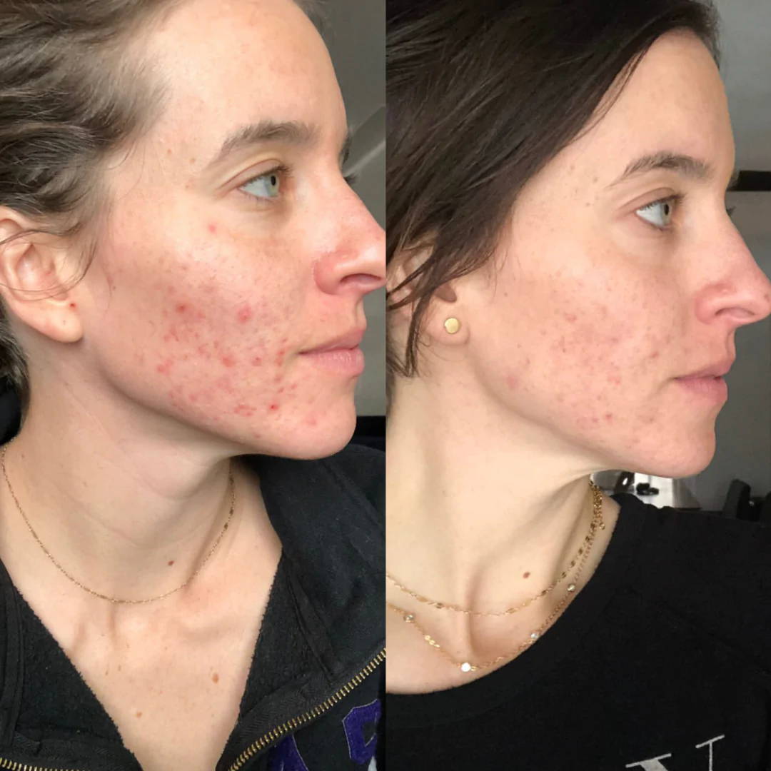 Before and after using fitish beauty skincare
