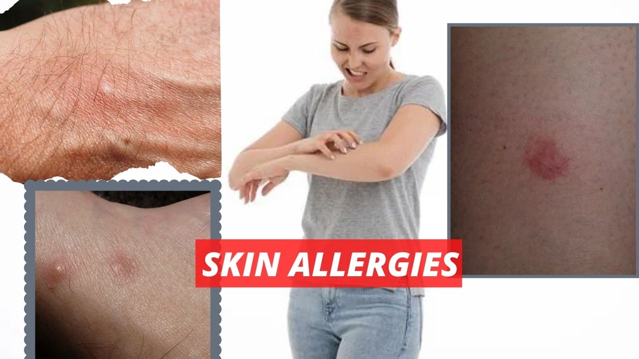 What is skin allergy? home remedies for the prevention of skin allergy