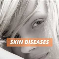 Skin Diseases : Prevention of Skin Diseases