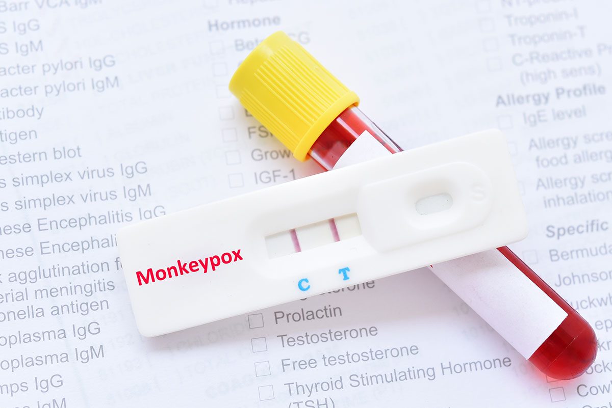 I'm a Doctor and Beg Everyone to Read This Monkeypox Warning