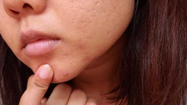 Tips and Treatments To Eliminate Blackheads