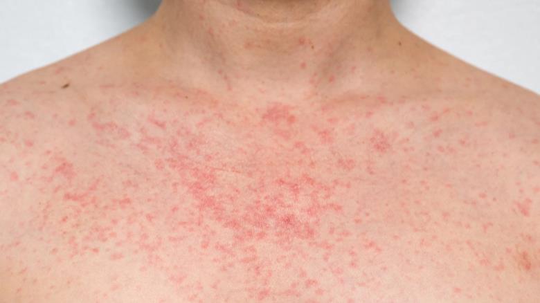 Beating the Heat: Expert Advice on Preventing and Treating Heat Rash