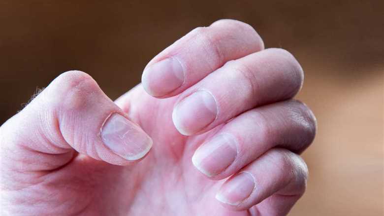 Understanding the Battle: Nail Psoriasis vs. Nail Fungus