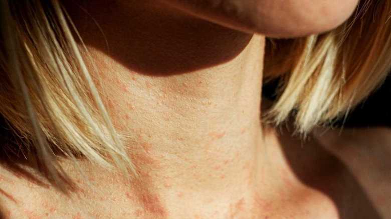 Revolutionary Eczema Relief: Dermatologists Unveil Game-Changing Tips
