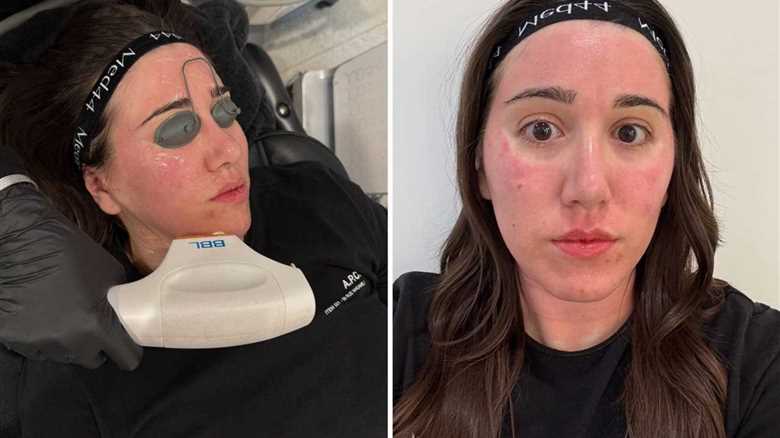 Revolutionary Laser Layering Technique: A Beacon of Hope for Skin Concerns